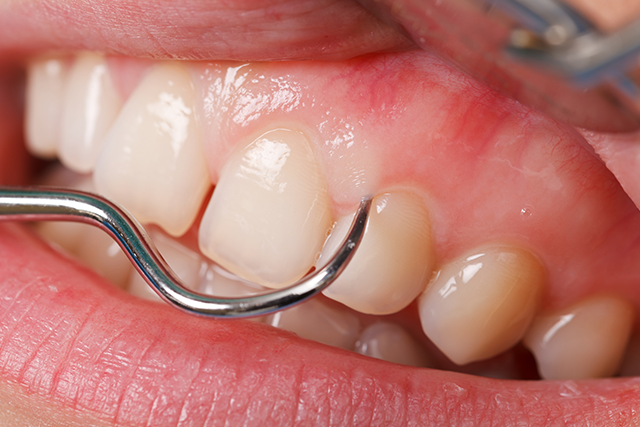 歯周病の予防法と治療方法